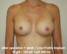 plastic-surgery-breast-augmentation